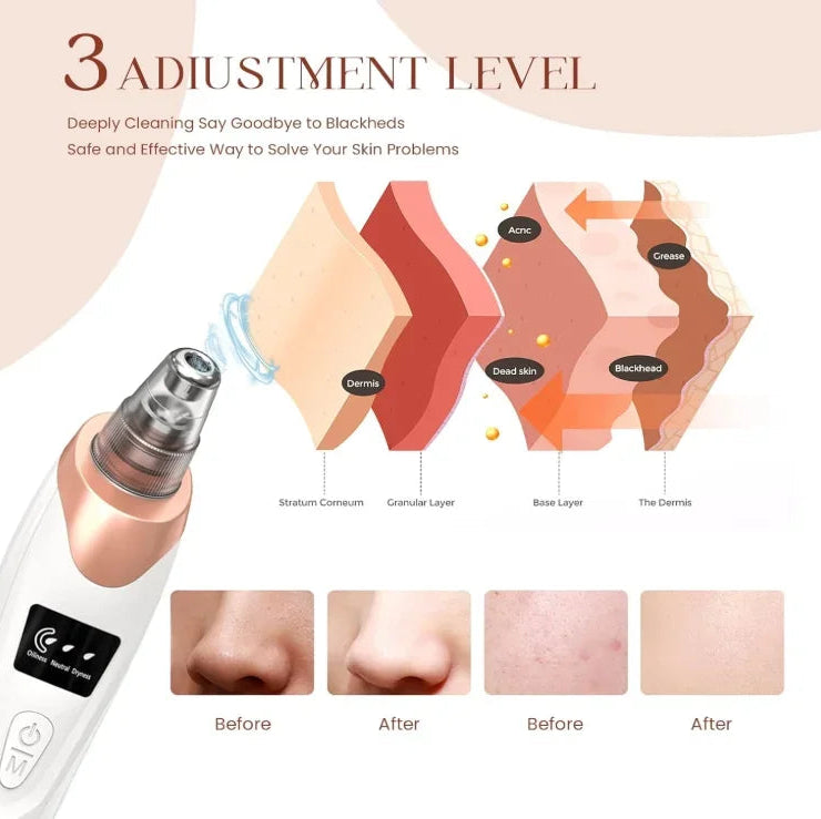 Blackhead Remover Pore